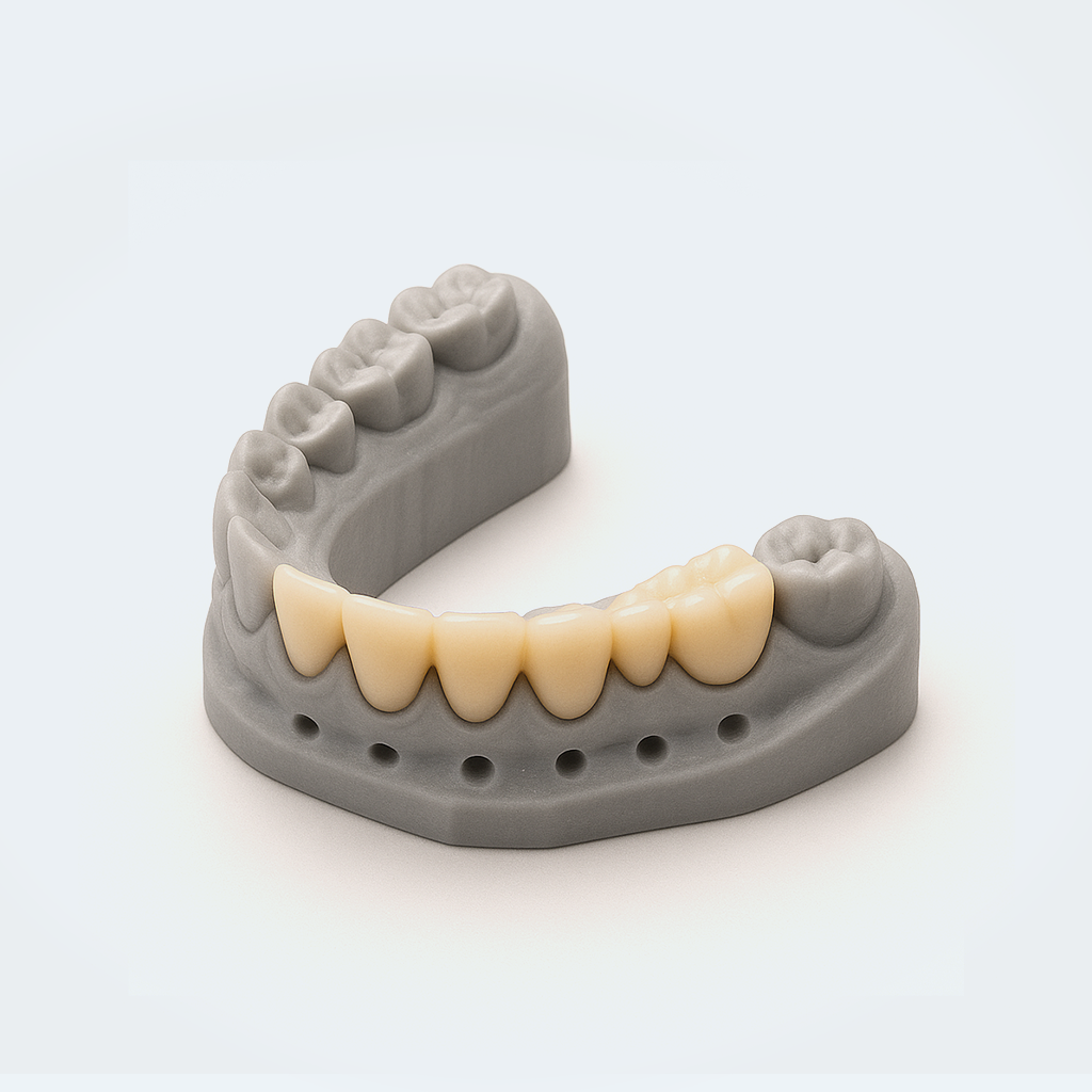 Couronnes, Bridges et Onlays