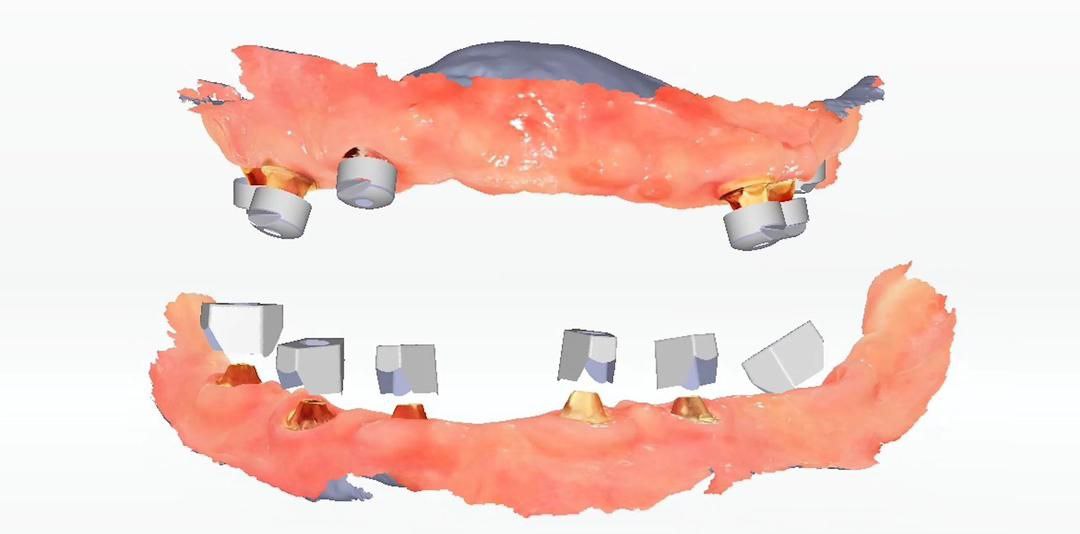 Scanner 3D Dentaire Intra-oral Shining 3D Aoralscan Elite